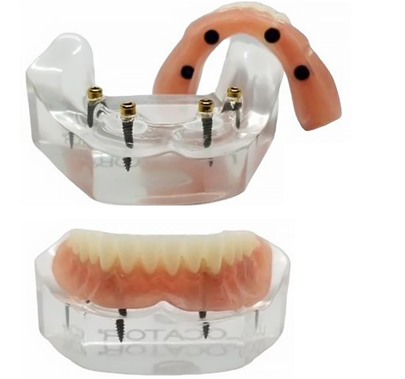 Snap-In Implant Dentures (Removable) in Cumming